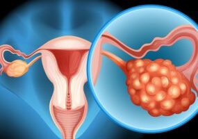 ROMA-Ovarian-Cancer-Thumbnail